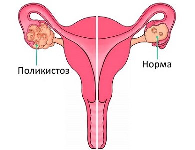 Травы при поликистозе яичников