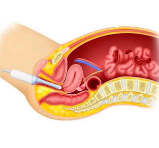 УЗИ малого таза во время месячных