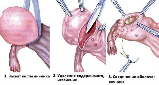 Удаление кисты яичника