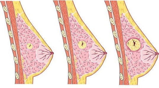 Увеличенные лимфоузлы в подмышках перед месячными при мастопатии