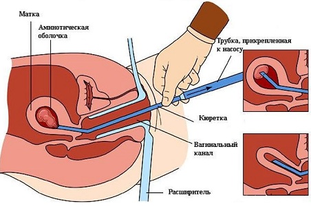 Вакуумная аспирация (мини-аборт)