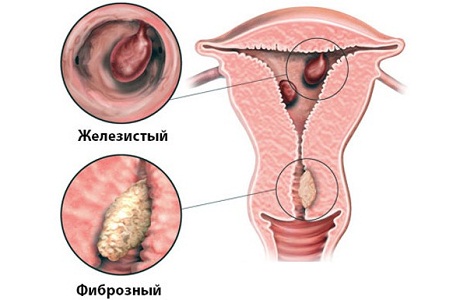 Виды полипов эндометрия