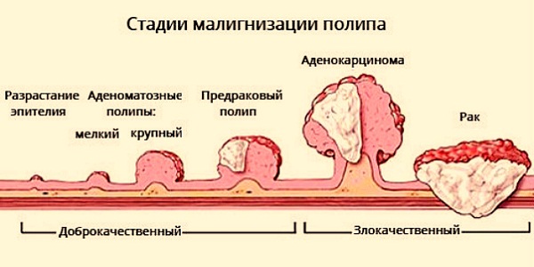 Виды полипов эндометрия