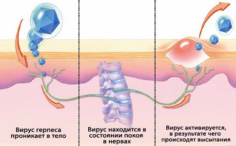 Вирус герпеса у женщин