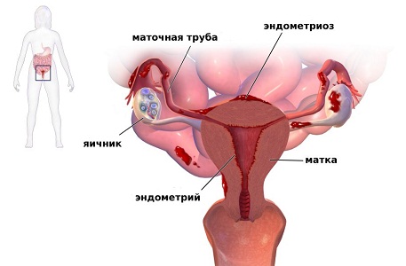 Визанна при лечении эндометриоза