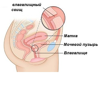 Влагалищный свищ