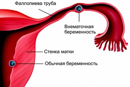 Внематочная беременность после Постинора