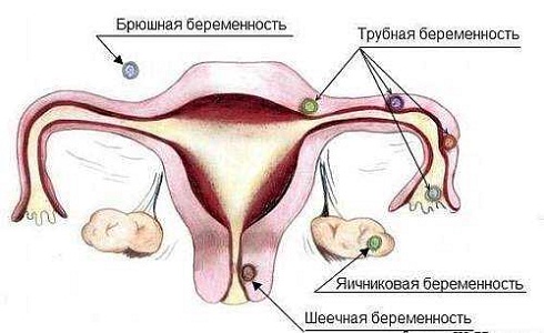 Внематочная беременность при климаксе