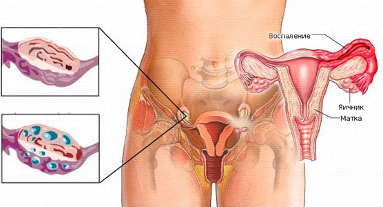 Воспаление кисты яичника у женщин