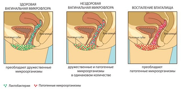 Возникновение молочницы при нарушении микрофлоры