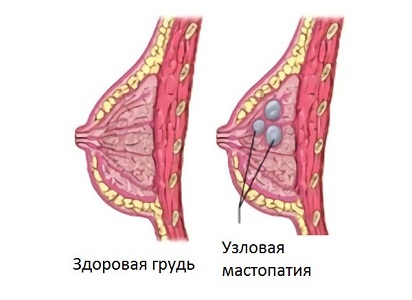 Выделения из груди при мастопатии