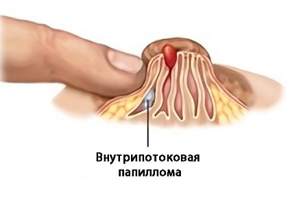 Выделения из груди при внутрипотоковой папилломе