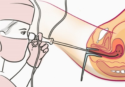 Выделения после процедуры гистероскопии