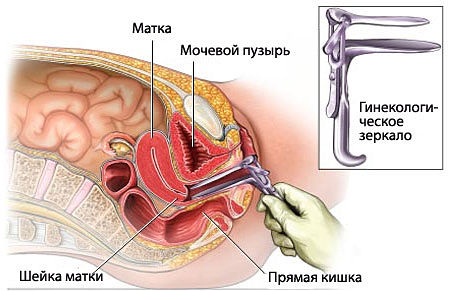 Выделения при травмировании гинекологическим зеркалом