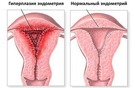 Выявление гиперплазии с помощью гистероскопии