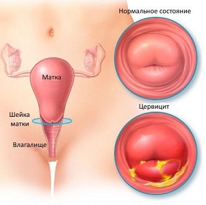 Заболевание цервицит