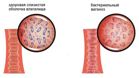 Зеленые выделения при бактериальном вагинозе