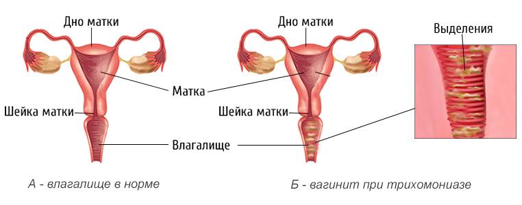 Зеленые выделения у женщин при трихомониазе