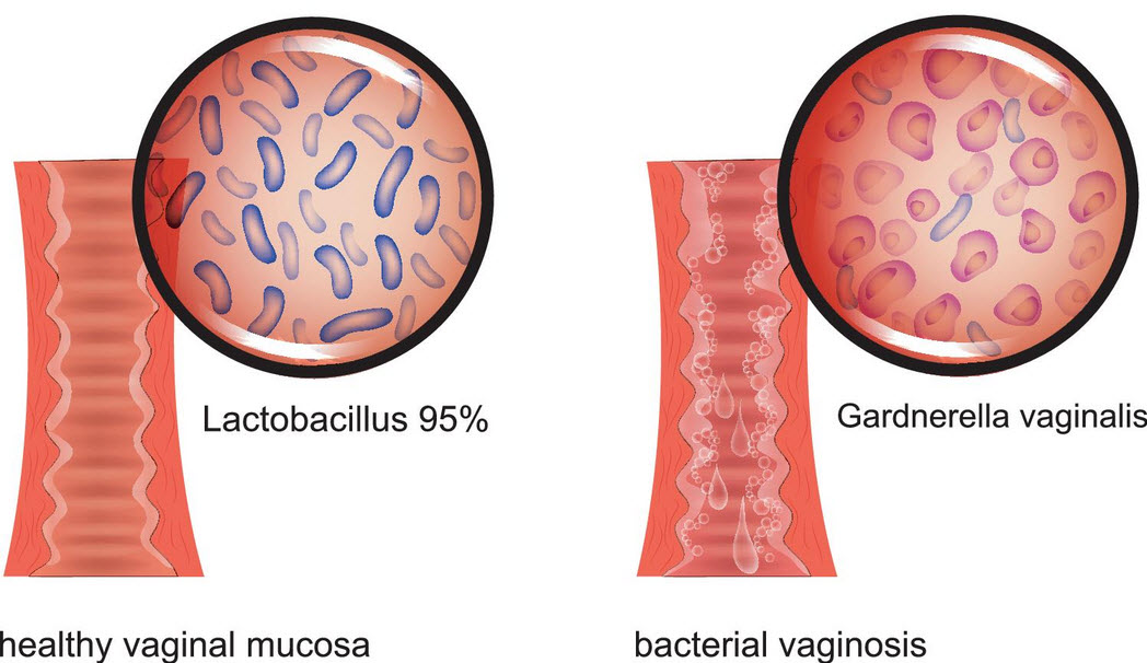 Бактериальный вагиноз