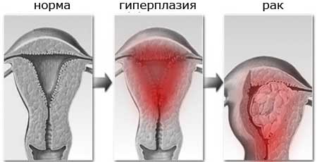 Гиперплазия эндометрия и рак