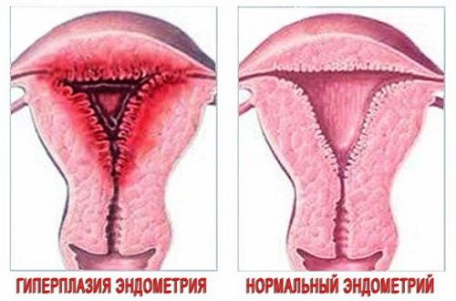 Гиперплазия эндометрия