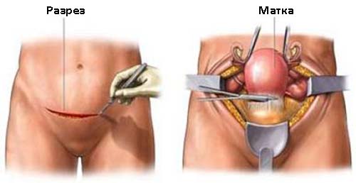 Хирургические лечение гиперплазии эндометрия