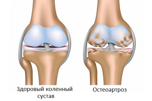 Остеоартроз при климаксе