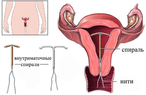 показания к установке внутриматочных спиралей