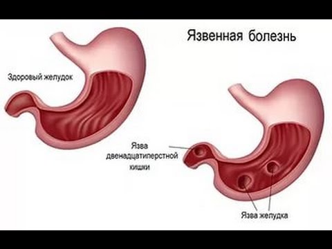 Противопоказания к применению препарата Найз