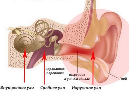 Наружный отит