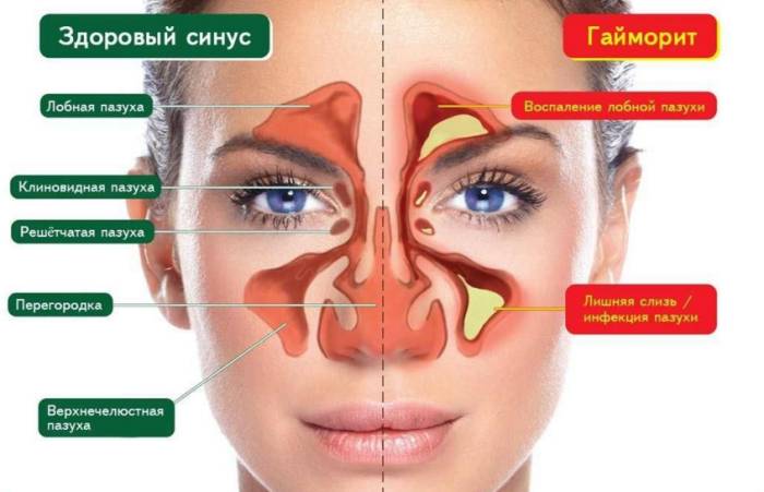 Острый гайморит