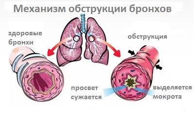 Механизм обструкции бронхов