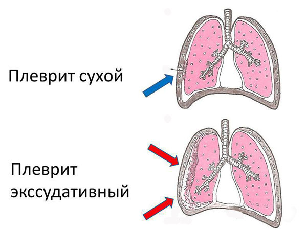 Виды плеврита