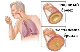 Воспаление бронха