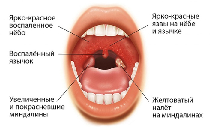 Признаки тонзиллита