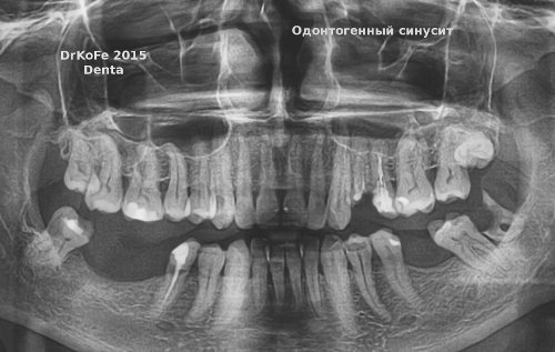 Снимок одонтогенного гайморита