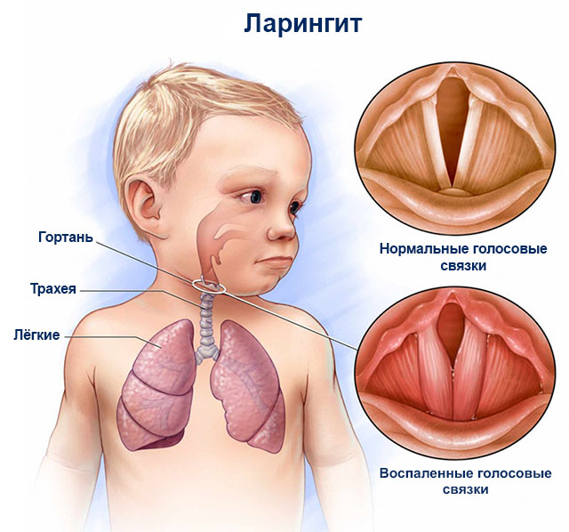 Ларингит у детей