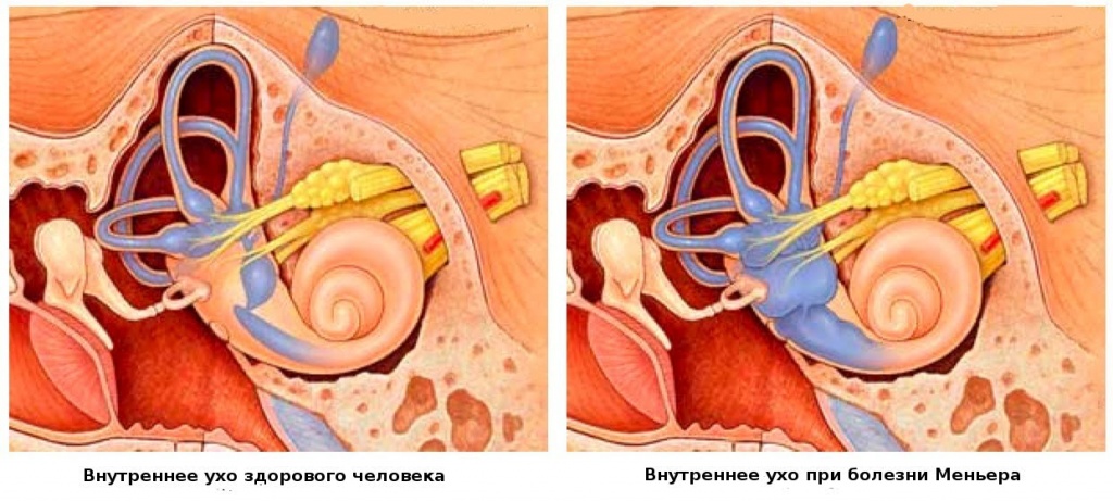 Схематическое отображение болезни Меньера