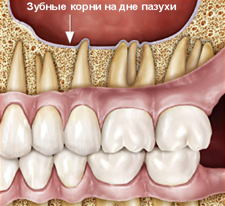 Корни зубов на дне гайморовой пазухи