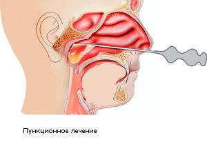 Пункционнное лечение одонтогенного синусита 