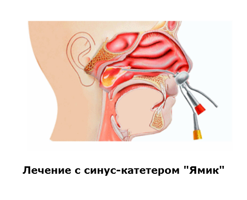 Лечение гайморита Ямик-катетером