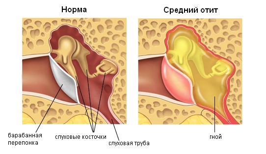 Схема воспаления при среднем отите