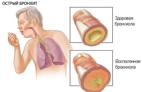 Хронический бронхит 