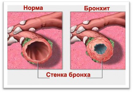 Бронхи при воспалении