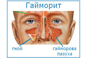 Гайморит