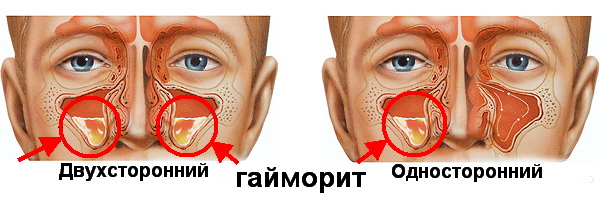 Односторонний и двухсторонний гайморит