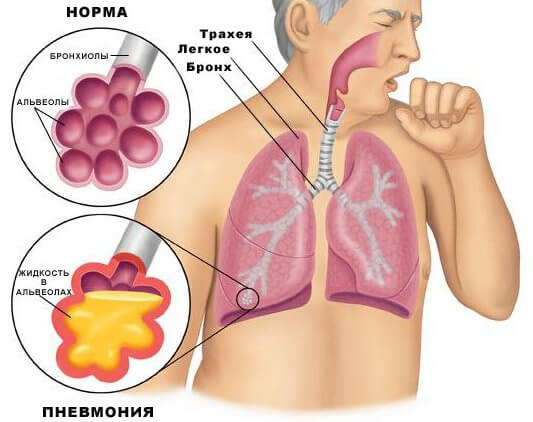 Пневмония