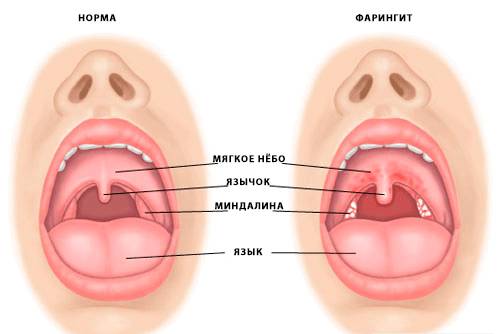 Грибковый фарингит
