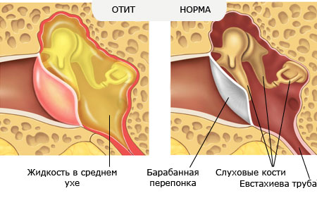 Отит среднего уха