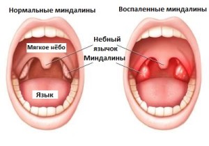 Воспаленные миндалины при ангине